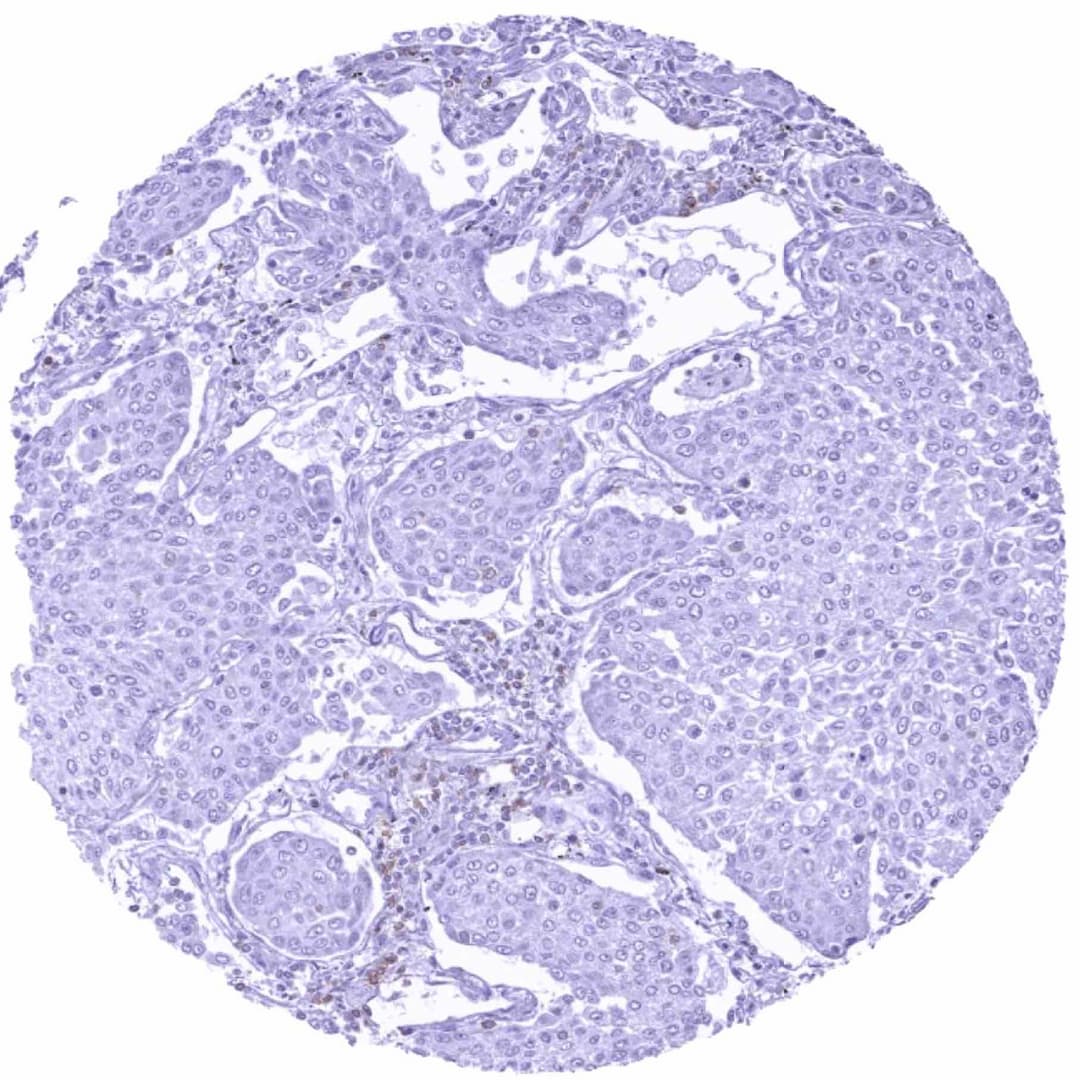 Lung – TIGIT negative squamous cell carcinoma containing some TIGIT positive lymphocytes